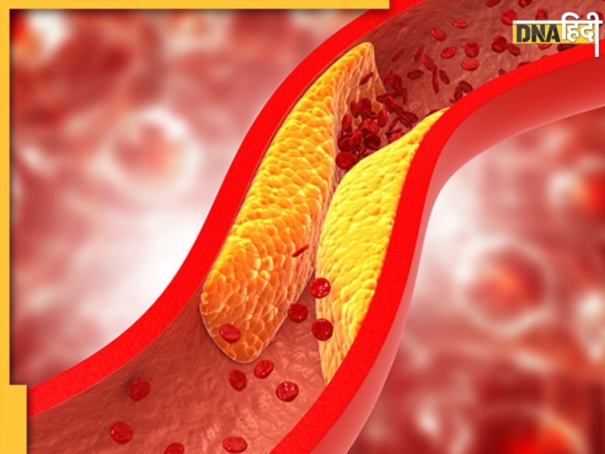 Cholesterol Treatment: शरीर के इन अंगों को भयंकर नुकसान पहुंचाता है बढ़ा हुआ कोलेस्ट्रॉल, अनदेखा करना पड़ सकता है भारी