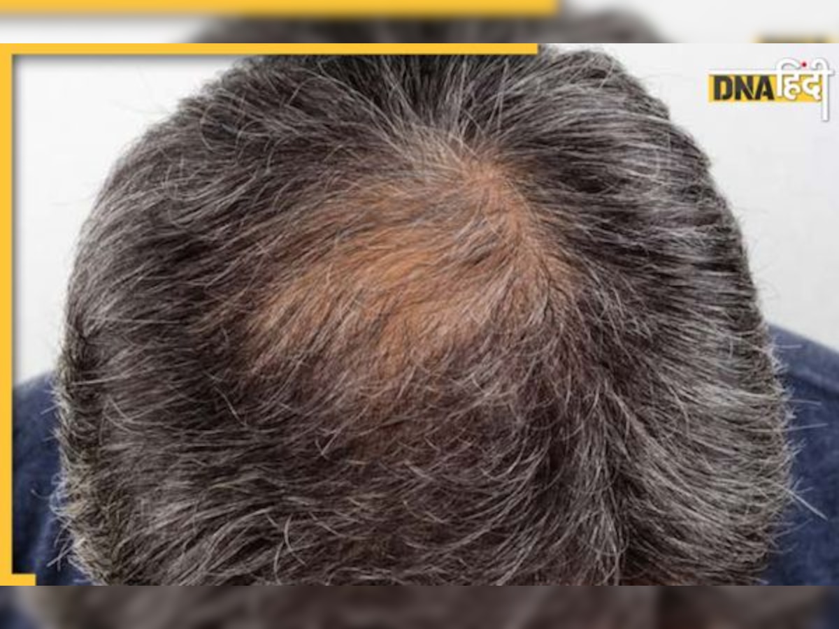 Hair Loss Remedy: ये 6 जड़ी-बूटियां गंजी हो चुकी खोपड़ी पर ��उगा देती हैं बाल, Hair Loss की है ये बेस्ट रेमेडी