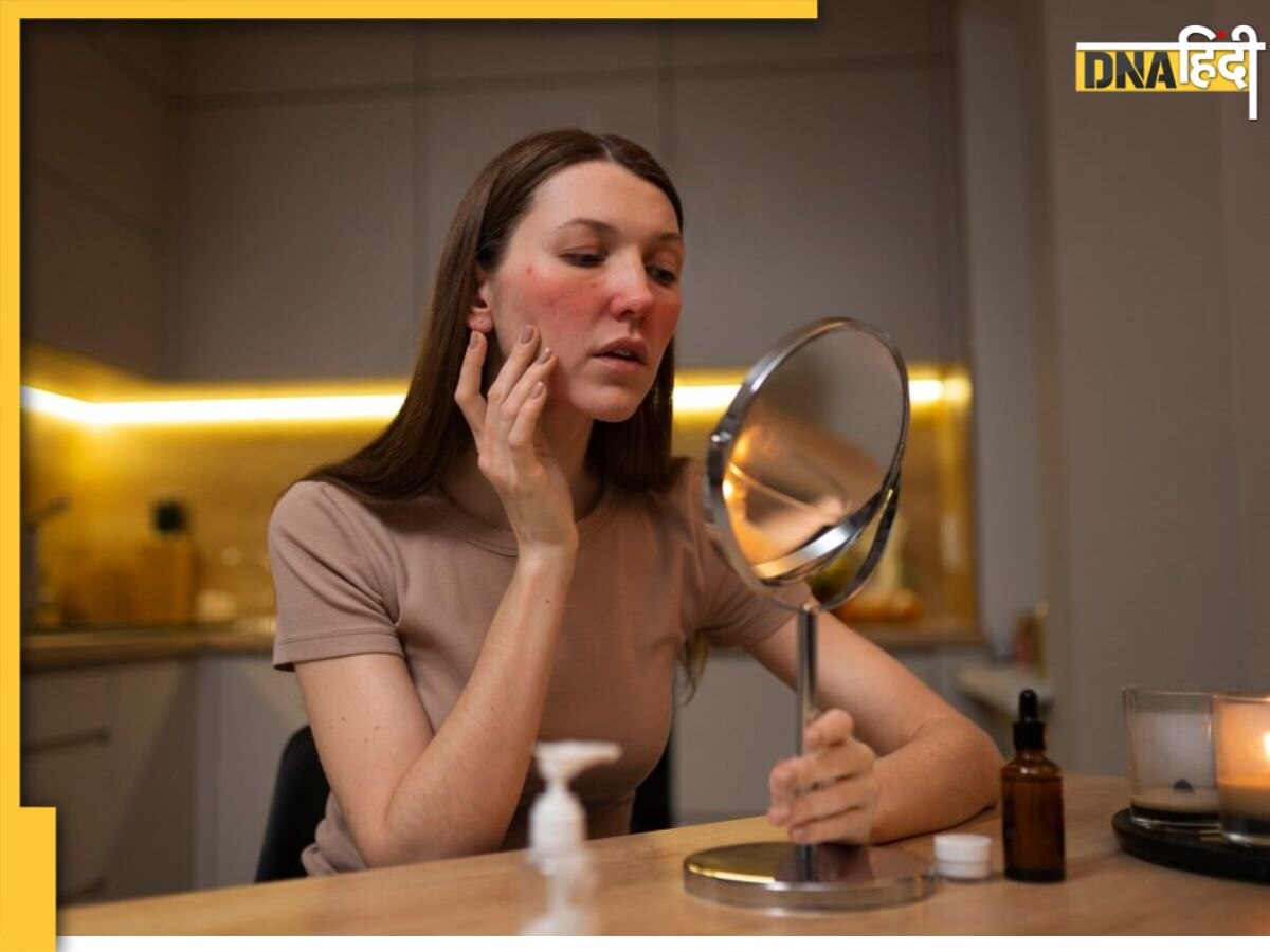 Acne या Pimples नहीं, चेहरे पर निकलने वाले लाल दाने हो सकते हैं इस गंभीर बीमारी के संकेत  