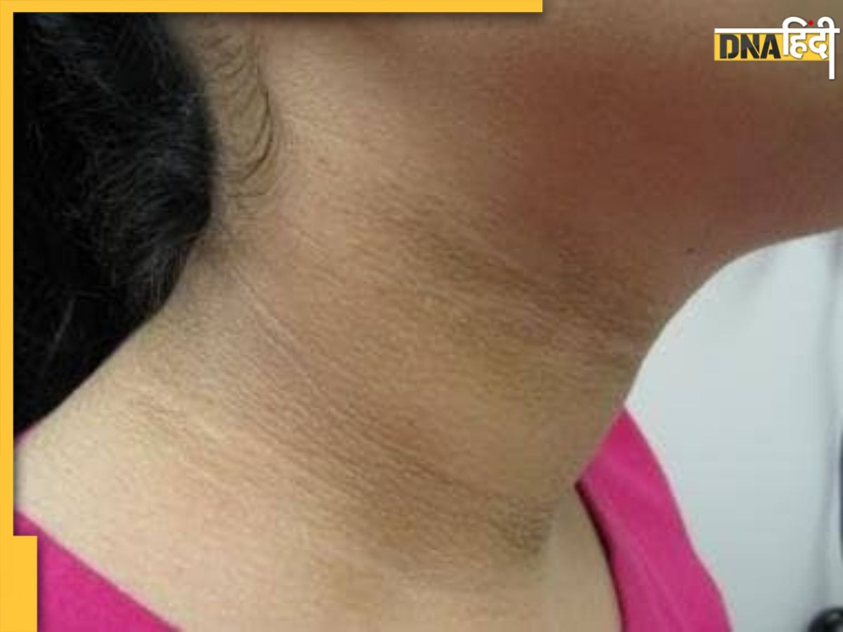 Dark Neck Causes: मैल नहीं, इन 4 गंभीर बीमारियों के कारण गर्दन पर जमने लगती है काली परत, न करें अनदेखा 