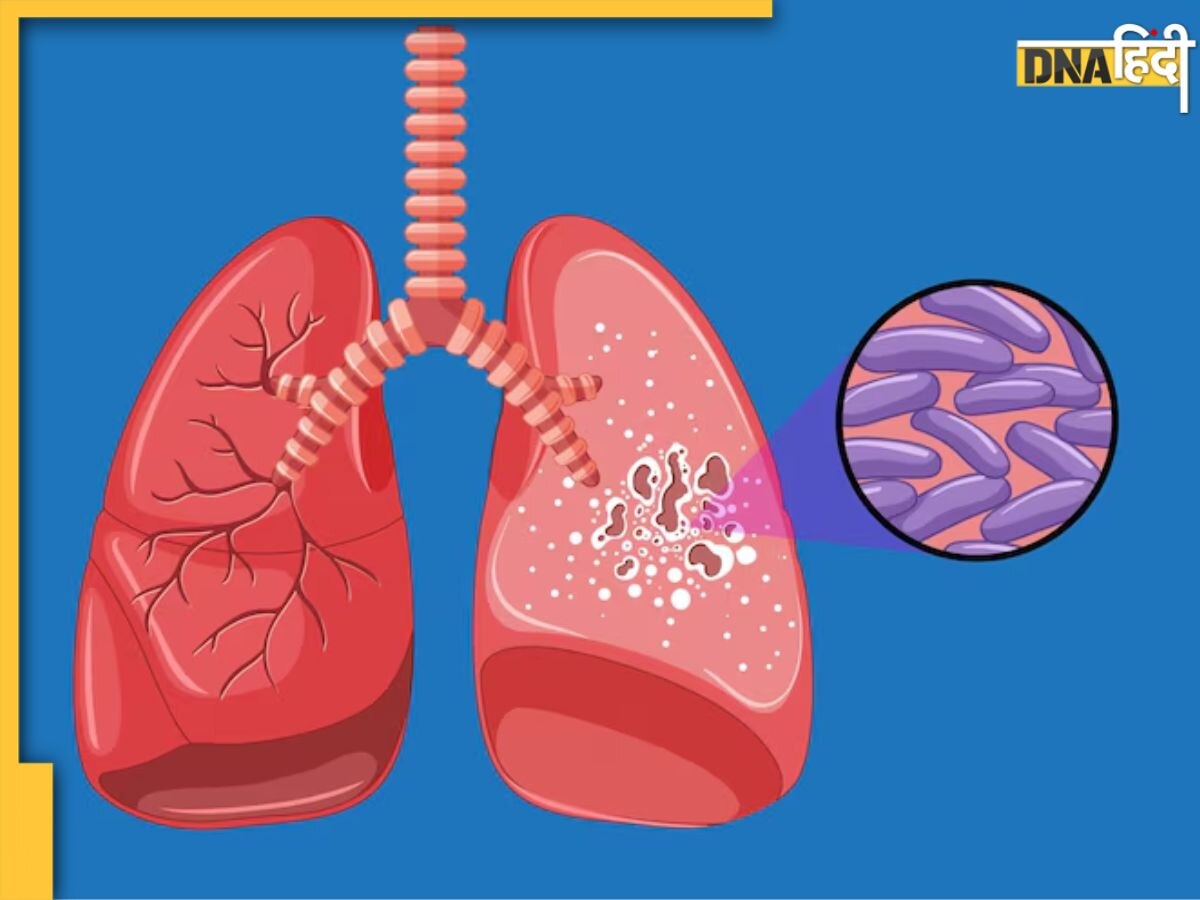 World TB Day 2024: शरीर में दिखने वाले ये सामान्य लक्षण हो सकते हैं टीबी के संकेत, 'STOP' टेक्नीक से करें बचाव