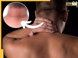 गर्दन और कोहनी के कालेपन के कारण झेलनी पड़ती है शर्मिंदगी, इन 3 उपायों से चमकने लगेगी त्वचा