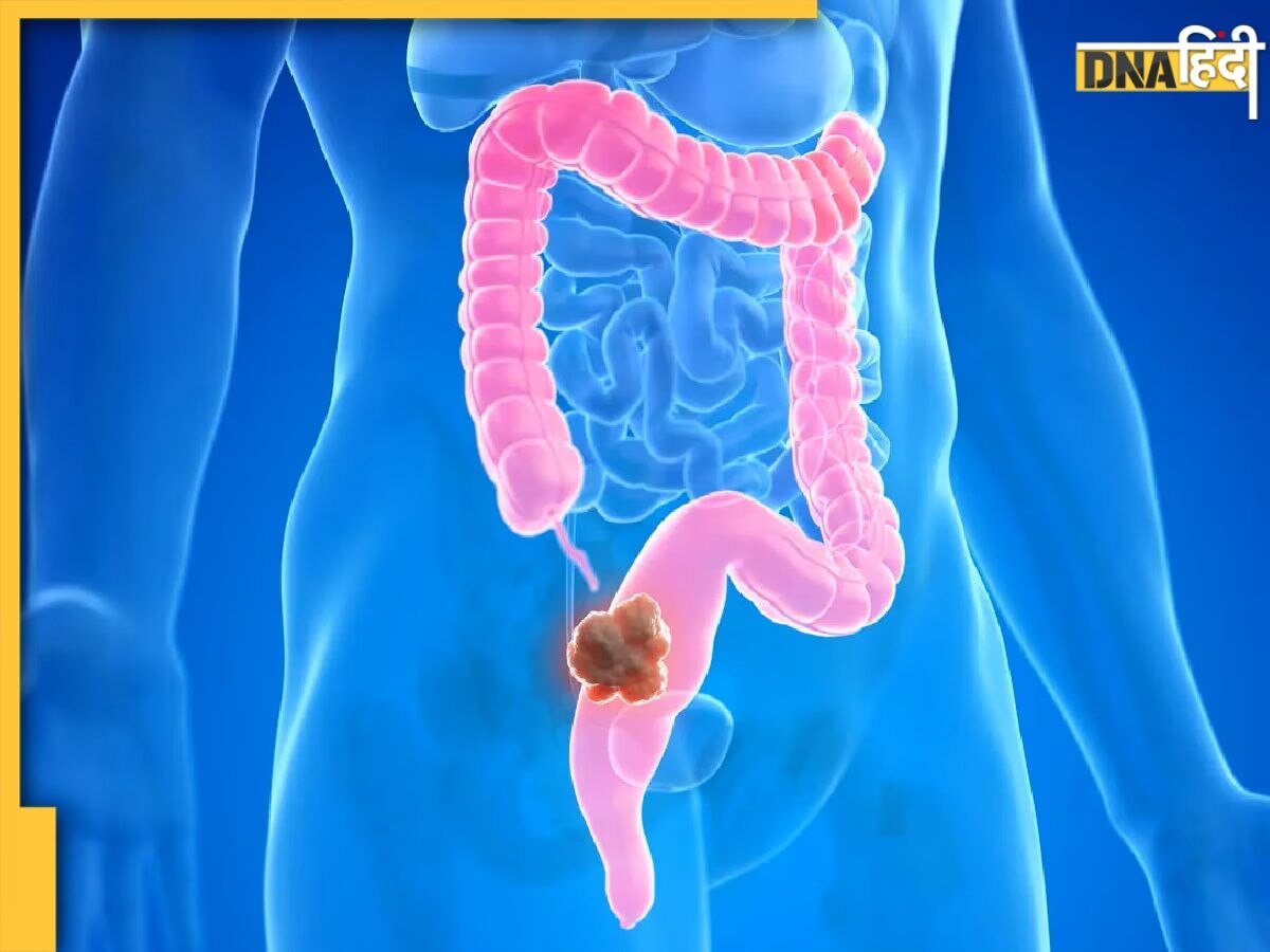 Stomach Cancer Symptoms: शरीर में दिखने वाले ये बदलाव कोलन कैंसर का लक्षण हो सकते हैं