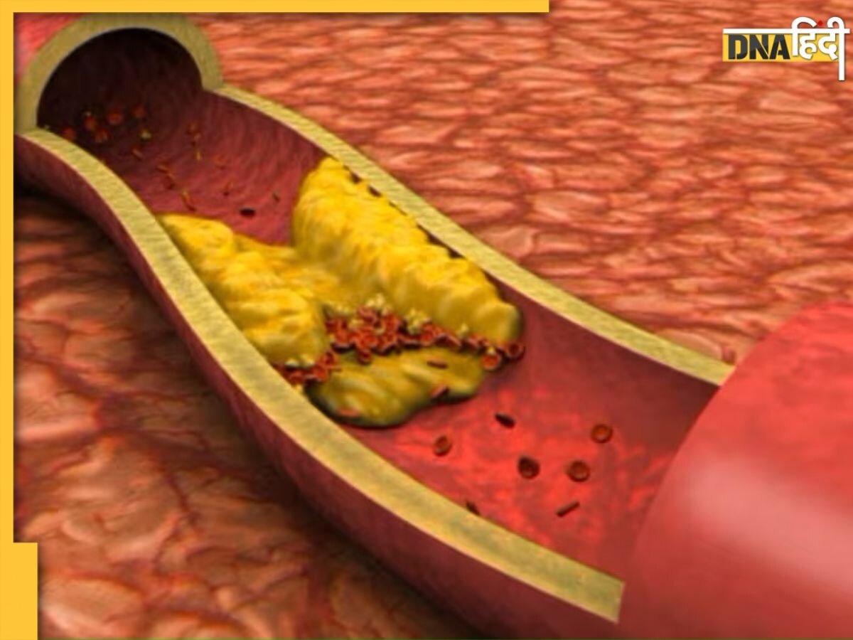 Bad Cholesterol Control: खराब कोलेस्ट्रॉल कम करने के लिए हर दिन करें ये 7 काम, धमनियों से निकलती जाएगी चर्बी
