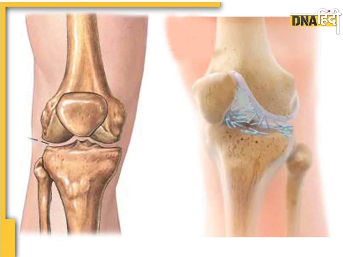 Uric Acid Symptoms: यूरिन में दिखने वाले ये 5 संकेत हाई यूरिक एसिड के हैं, समझ लें नष्ट हो रहा जोड़ों का कार्टिलेज 