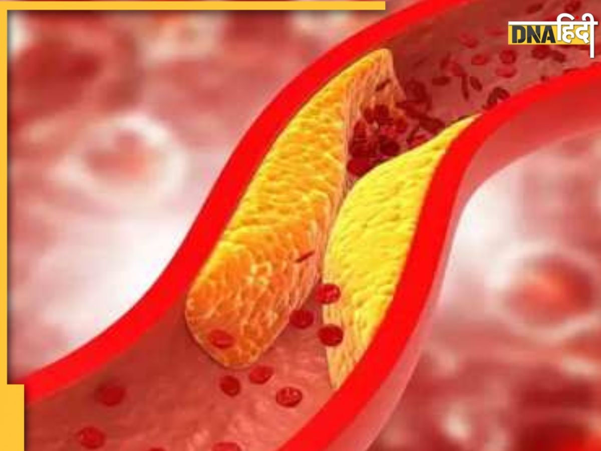 Good cholesterol Remedy: ये 10 चीजें धमनियों में फंसे कोलेस्ट्रॉल को खींचकर बाहर लाती हैं, नसों की ब्लॉकेज होगी खत्म