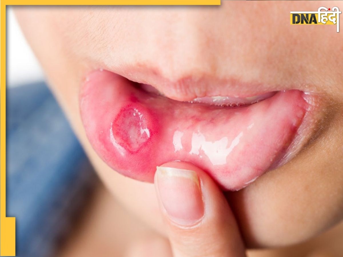 White Blister Risk: सफेद छाले इस गंभीर स्थिति का हैं संकेत, जानिए किन वजहों से पकता है मुंह