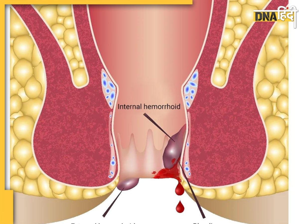 Bloody Piles Treatment:  खूनी बवासीर की समस्या को दूर करेगी किचन में मौजूद ये पीली चीज, बस ऐसे करें इस्तेमाल