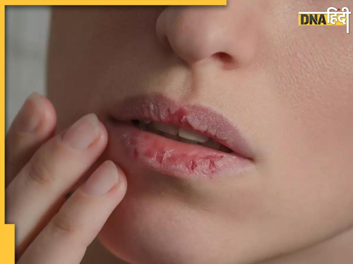 Chapped Lips Remedy: गर्मी में होंठों का फटना या खून आना, शरीर में इस कमी का देता ��है संकेत