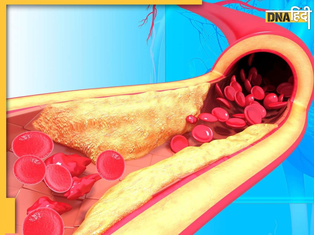 Cholesterol Remedy: हाई कोलेस्ट्रॉल से परेशान हैं? तो आप इन 10 फूड्स को खाना शुरू करें, मक्खन की तरह पिघलेगी वसा