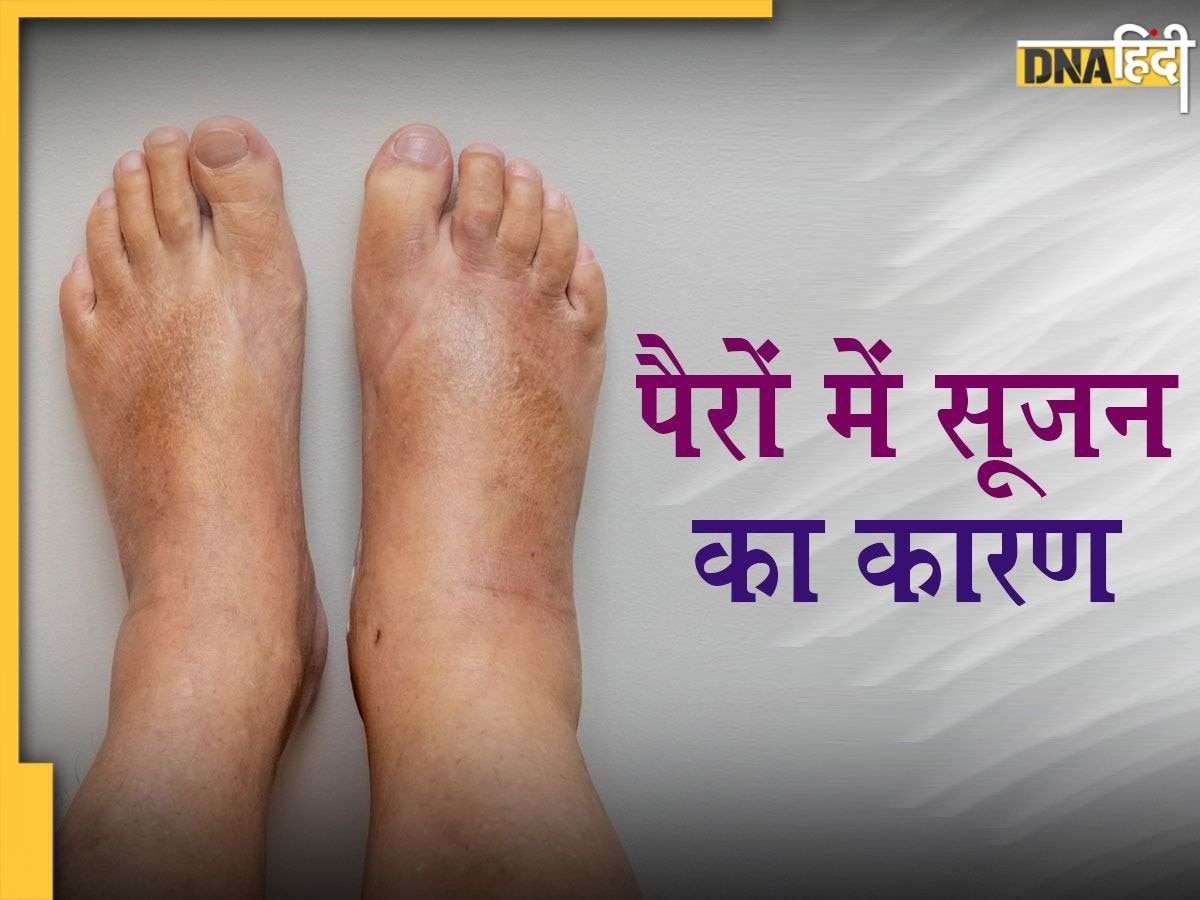 Swelling in Feet: पैर या तलवे में सूजन इन गंभीर बीमारियों का शुरुआती संकेत, जरा सी लापरवाही जान पर पड़ेगी भारी