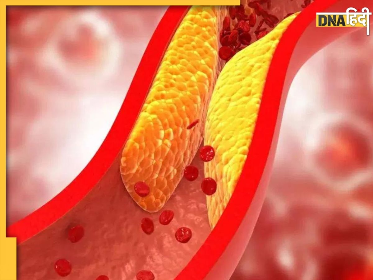 Cholesterol Remedy: नसों में फंसे गंदे कोलेस्ट्रॉल को पिघला देंगे ये 6 फूड्स, बढ़ जाए�गा ब्लड सर्कुलेशन