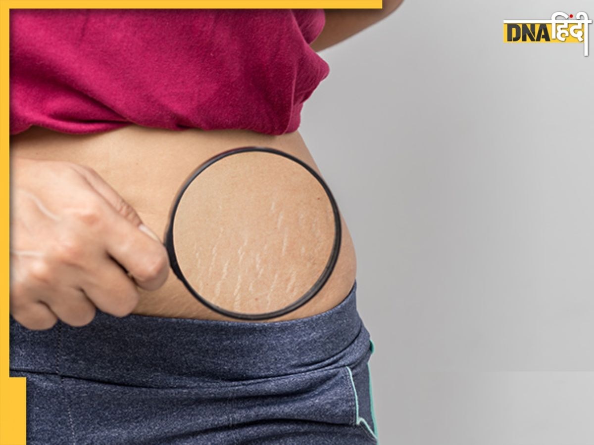 Stretch Marks Treatment: अब नहीं छुपाने पड़ेंगे स्ट्रेच मार्क्स, इन 5 आसान उपायों से दूर होंगे सारे निशान