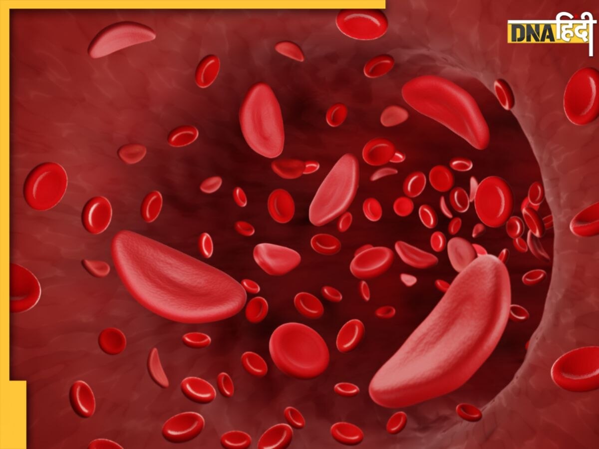 क्या है Sickle Cell की बीमारी? बचपन में ही दिखने लगते हैं इस जेनेटिक रोग के लक्षण