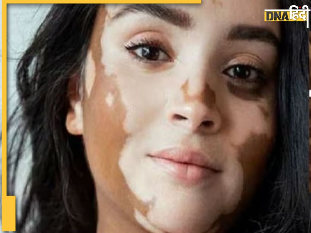 Vitiligo aka Safed Daag Symptoms: नहीं बदलीं ये आदतें तो सफेद दा��ग होने की बढ़ जाएगी संभावना, ऐसे होती है इस बीमारी की शुरुआत