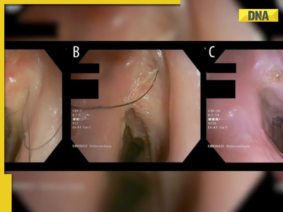 Bizzare: Man develops hair in throat due to...