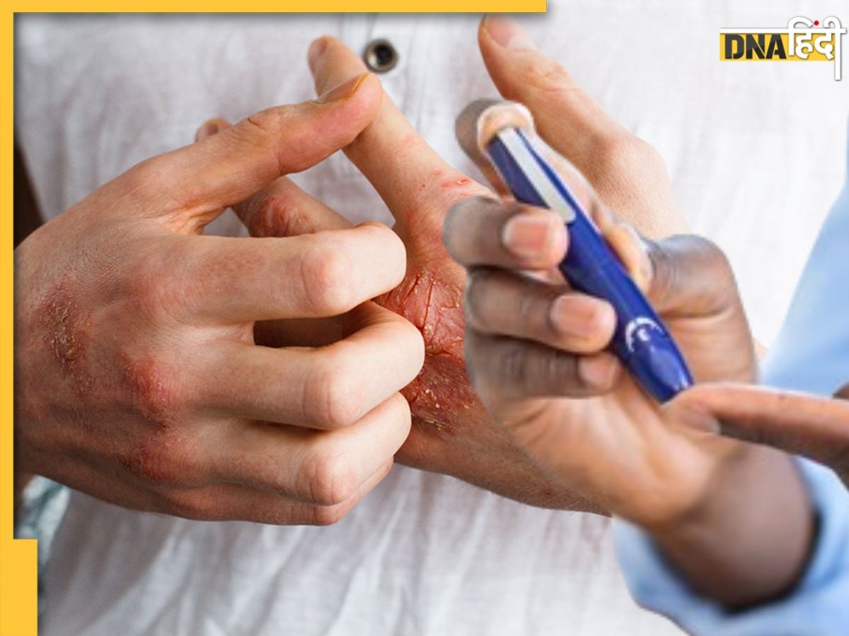 Diabetes: डायबिटीज की वार्निंग है स्किन पर नजर आने वाली ये समस्याएं, अनदेखी पड़ेगी भारी!