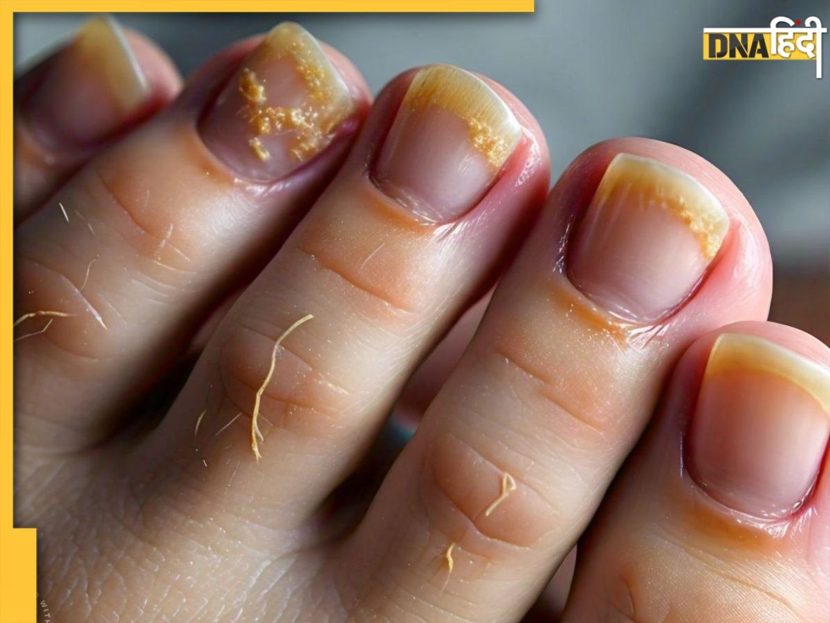 हाथ-पैर के नाखूनों में ये बदलाव Fungal Nail Infection का हैं संकेत, न करें इग्नोर