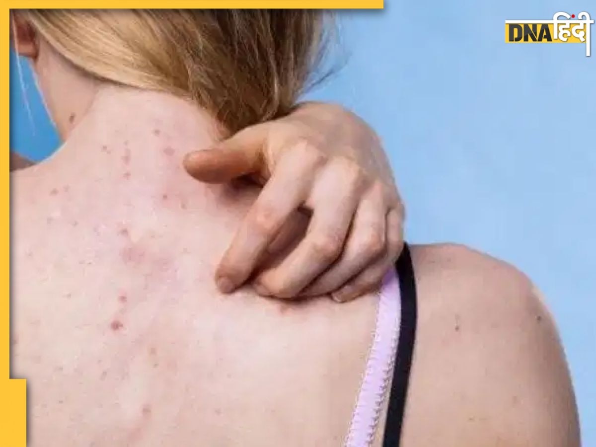 क्या छोटे-छोटे दानों से भरी पड़ी है पीठ? जानें Back Acne का कारण और बचाव के उपाय