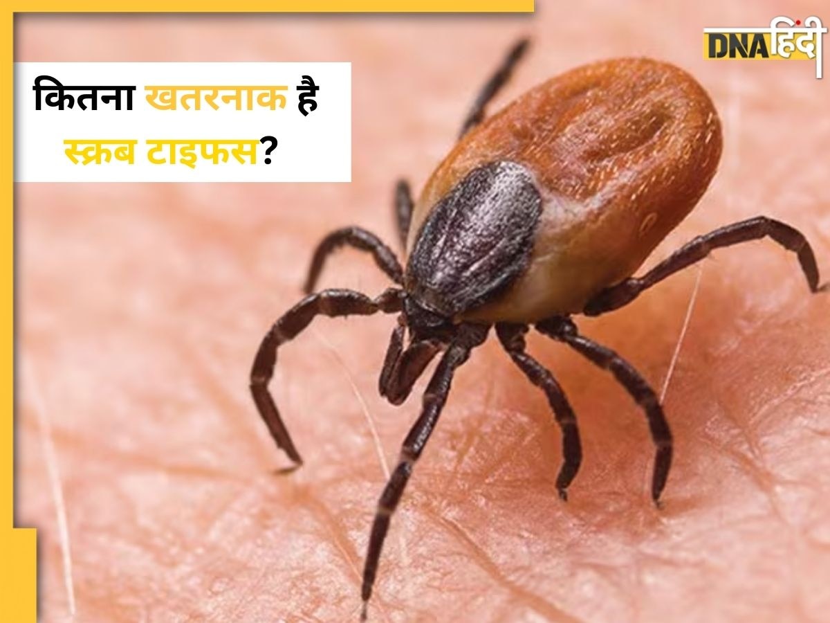 क्या है Scrub Typhus? शिमला में इस बीमारी से हुई पहली मौत ने बढ़ाई लोगों की चिंता