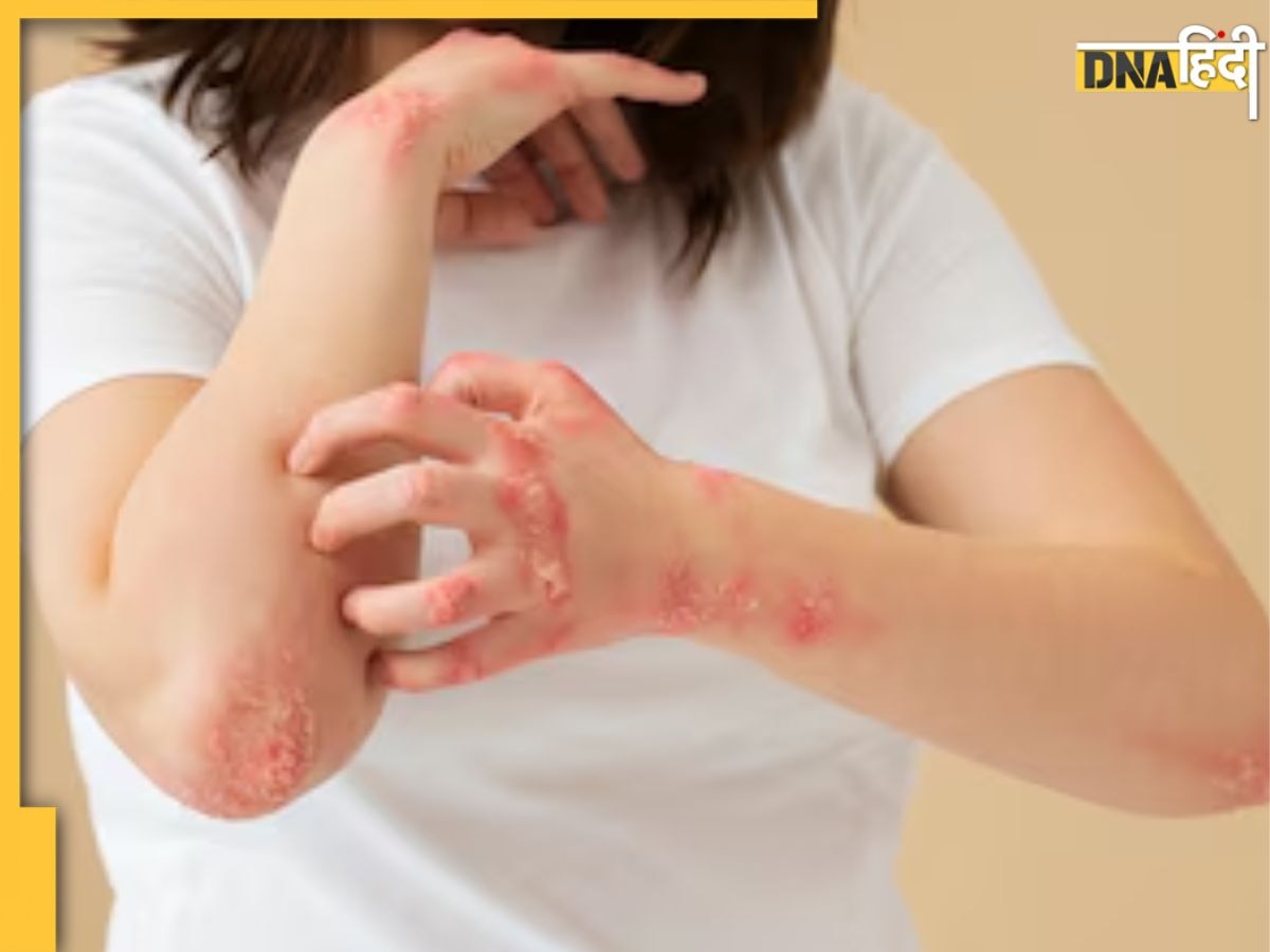 Remedies For Ringworm: बरसात के मौसम में परेशान कर रही है दाद, खाज और खुजली की समस्या, इन घरेलू उपायों से मिलेगा आराम