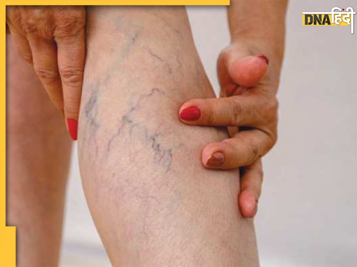 पैरों में नजर आ रही हैं नीली नसें तो हो गई है Varicose Veins की समस्या, इन 4 एक्सरसाइज से करें दूर