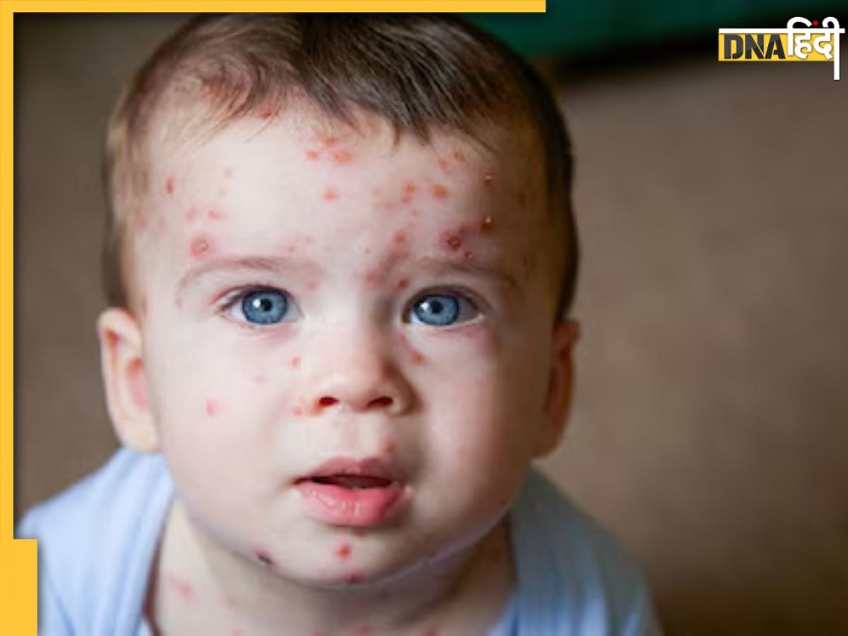 बड़ों से अधिक बच्चों को है Monkeypox Virus होने का खतरा, इन 10 लक्षणों से करें पहचान