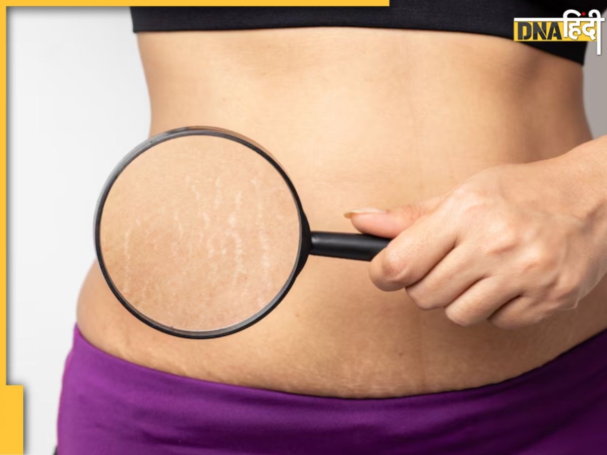 Stretch Marks से हमेशा के लिए मिल जाएगा छुटकारा, बस अपनाएं ये घरेलू उपाय