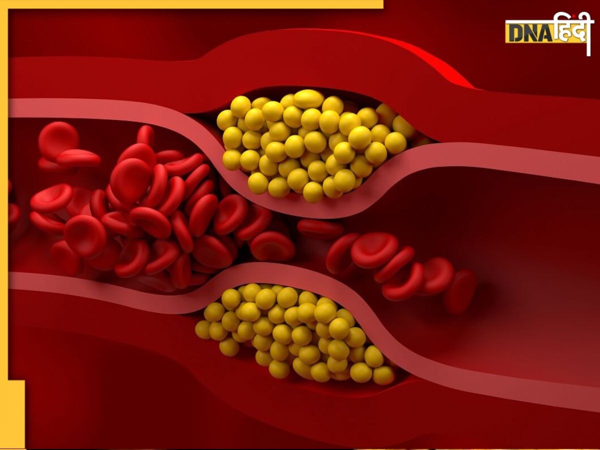 LDL Cholesterol Symptoms: चेहरे पर दिखें ये 6 लक्षण तो समझ लें शरीर में खराब कोलेस्ट्रॉल का लेवल बढ़ गया है