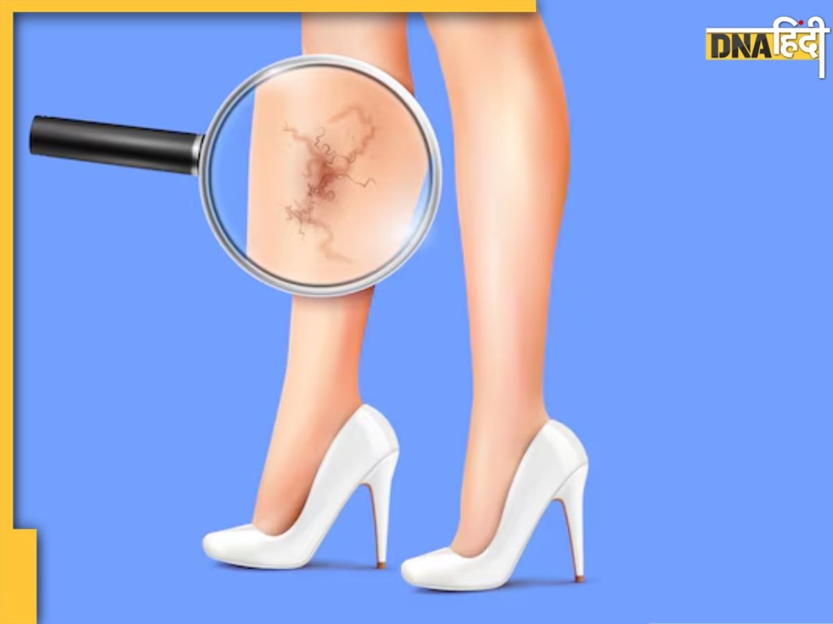 Varicose Veins: हाथ और पैरों में दिख रही हैं उभरी हुई नीली-बैंगनी नसें? कहीं आप इस गंभीर बीमारी के शिकार तो नहीं