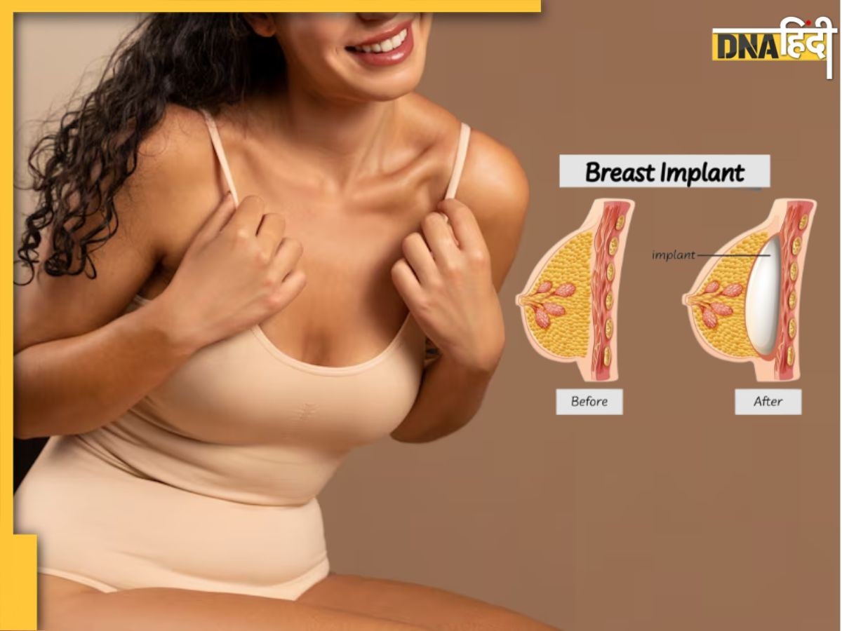 महिलाओं के बीच बढ़ रहा Breast Implant का ट्रेंड, जानें इसके क्या हैं जोखिम और कितना ��आता है खर्च