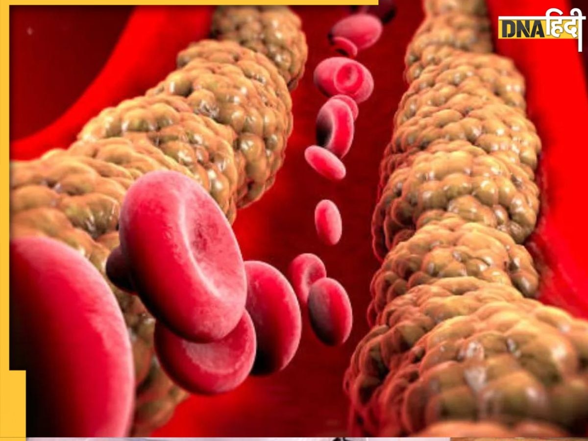 Cholesterol Remedy: इन फैट कटर फ्रूट्स से नसों में जमा बैड कोलेस्ट्रॉल घी की तरह पिघल कर आएगा बाहर