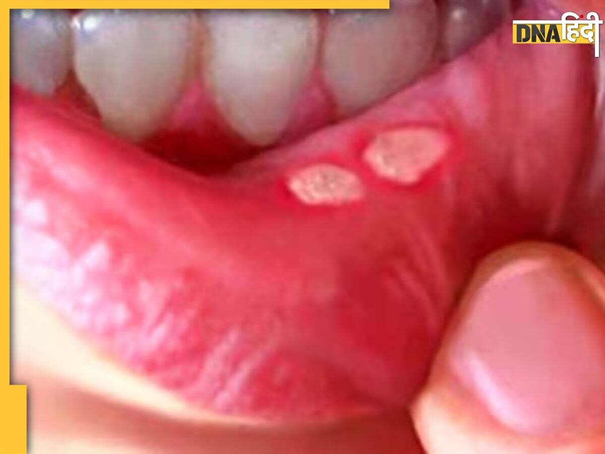 Mouth Ulcer Home Remedies: मुंह के छालों से हैं परेशान तो आजमा लें ये घरेलू उपाय, झटपट मिल जाएगा आराम