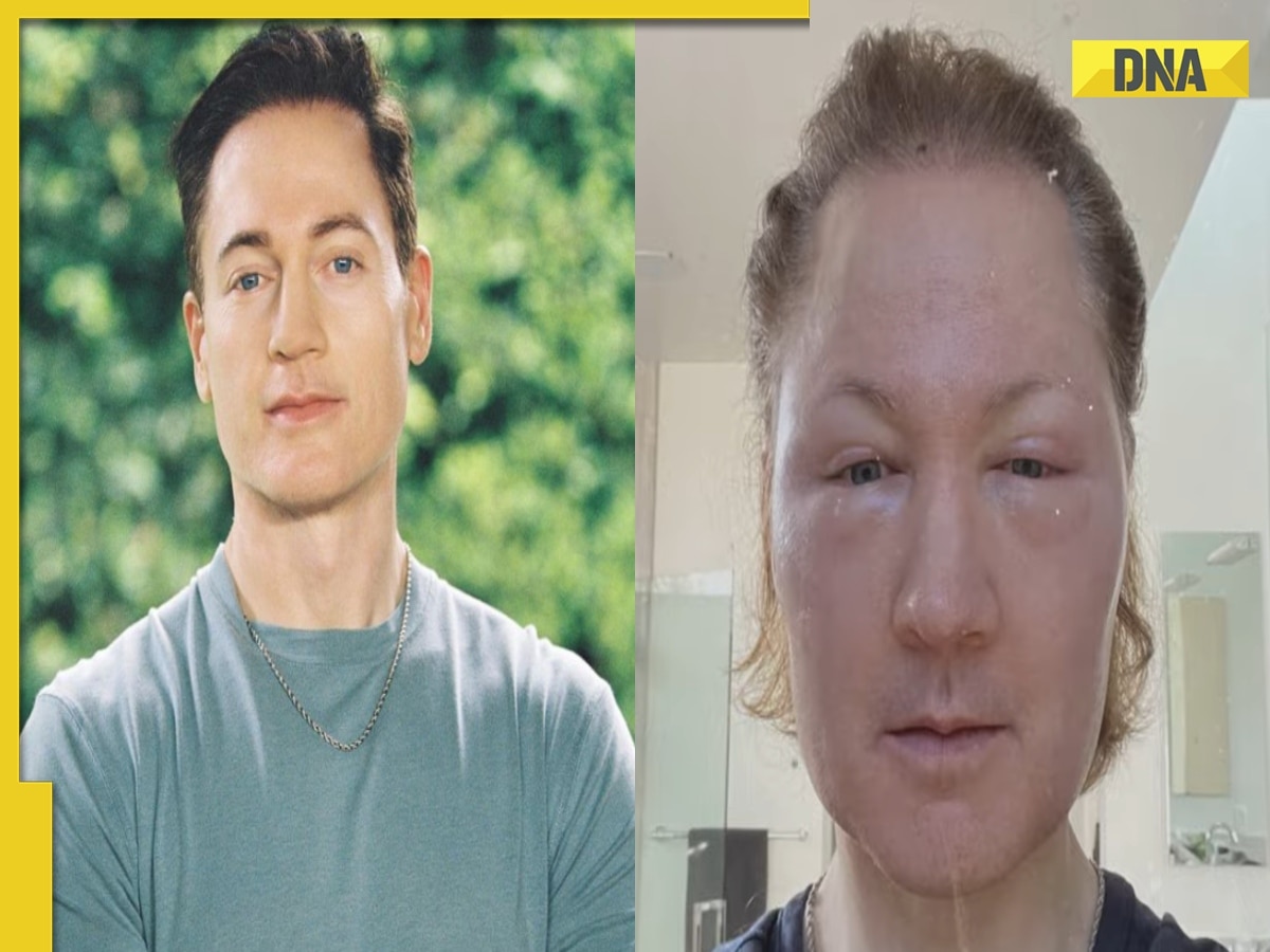 Tech millionaire attempts reverse ageing, get 'baby face': What happened next will leave you shocked