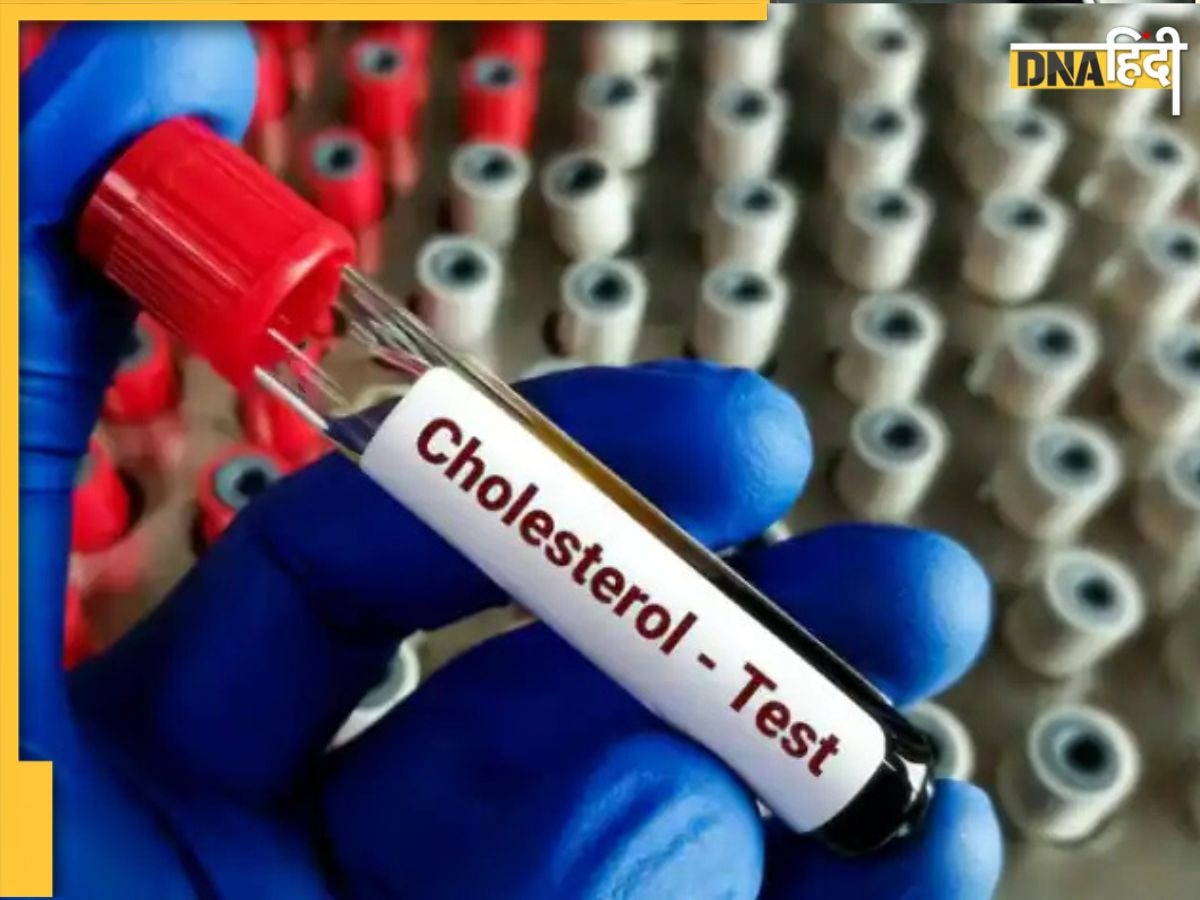 Cholesterol Test: प्लाक बिल्डअप की जांच करवाने से पहले याद रखने योग्य 5 बातें, तभी कोलेस्ट्रॉल की सही रीडिंग मिलेगी