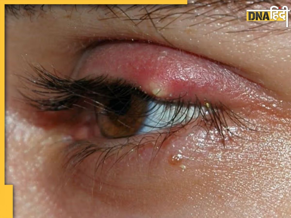 Chalazion Causes: आंखों की पलकों पर क्यों होती है गांठ? जानें कारण और बचाव के उपाय