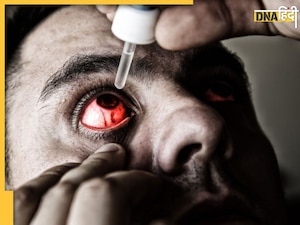 आंख, नाक या मुंह से अचानक खून आना... 'Bleeding Eye Virus' के हो सकते हैं ये खतरनाक लक्षण 