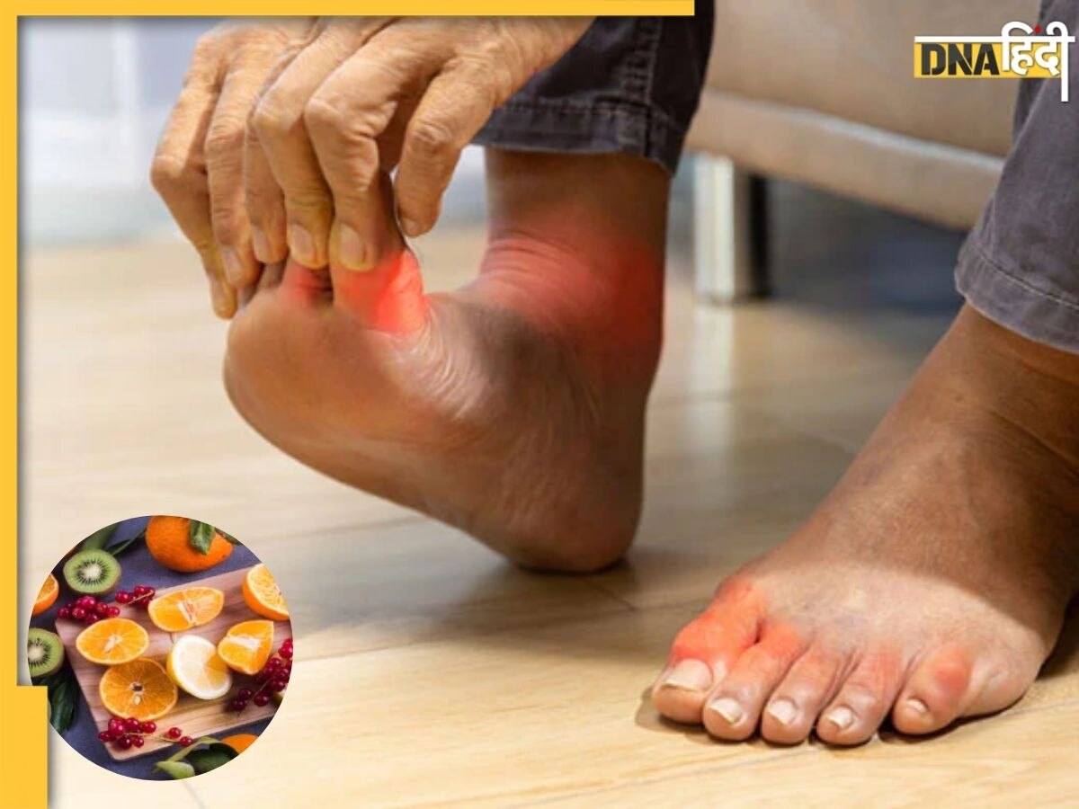 जोड़ों में जमा Uric Acid को कम करेगा ये एक विटामिन, Joint Pain होगी छुट्टी