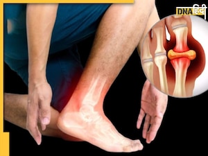 इन खतरनाक बीमारियों को न्योता देता है शरीर में बढ़ा हुआ Uric Acid, जानें इसके लक्षण