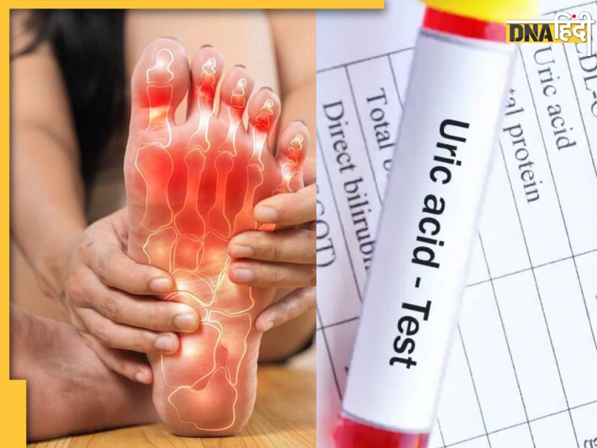 High Uric Acid की समस्या बन सकती है गाउट का कारण, जानें बचाव के लिए क्या उपाय करें?