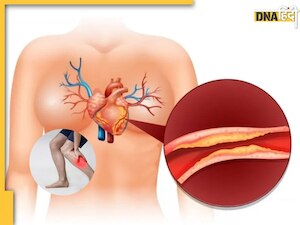 शरीर में दिखें ये 5 लक्षण तो समझ लें बढ़ने लगा है Bad Cholesterol, तुरंत कराएं जांच
