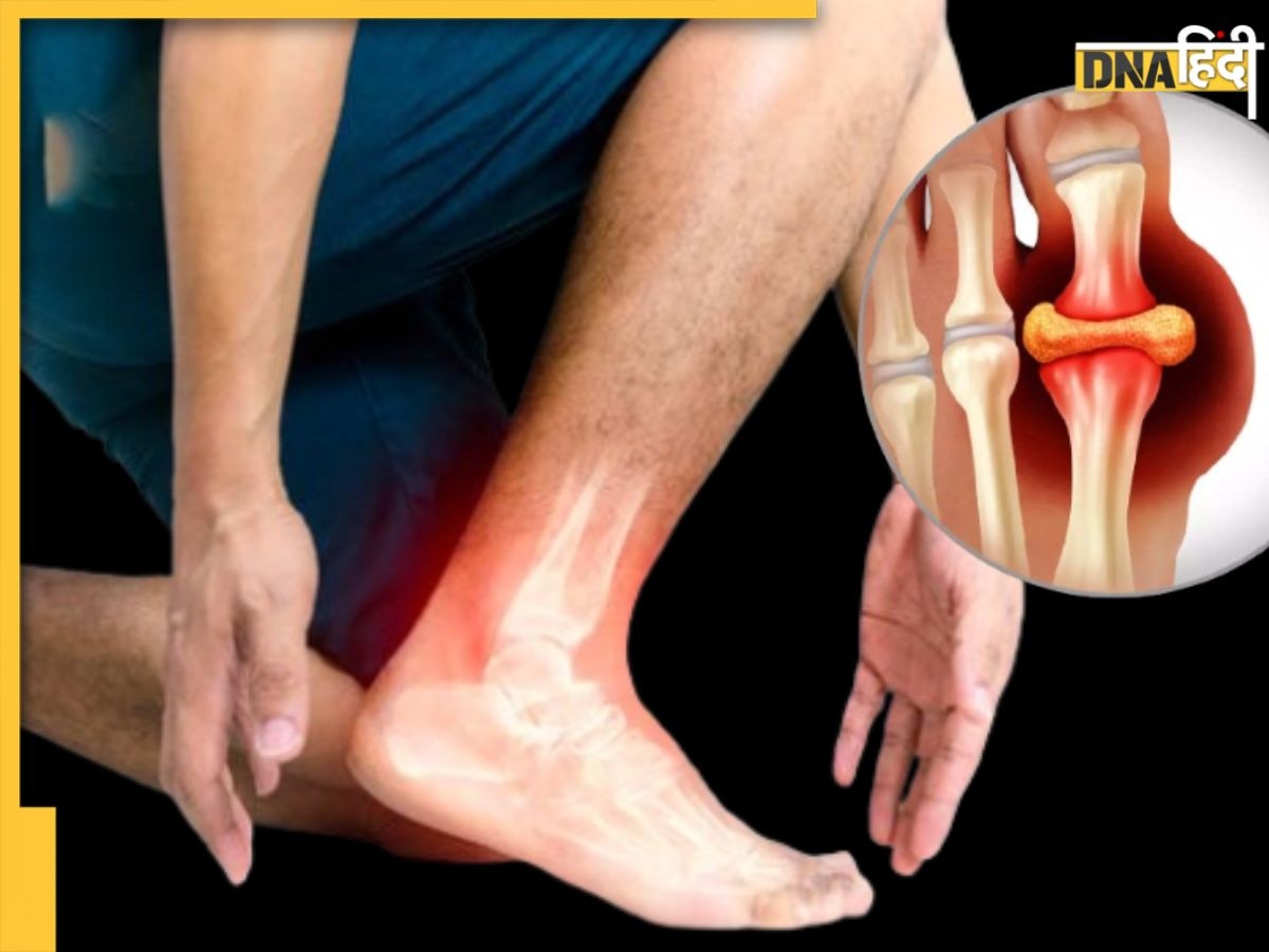 जोड़ों में जमा Purine बाहर निकाल देगी ये 1 चीज, Uric Acid के मरीज डाइट में कर लें शामिल