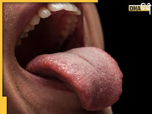 White Blisters Causes: बार-बार मुंह में पड़ रहे हैं सफेद छाले? कहीं इन बीमारियों के संकेत तो नहीं