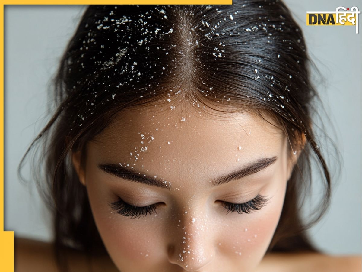 Dandruff से छुटकारा पाने के लिए अपनाएं ये आयुर्वेदिक नुस्खे, कुछ ही दिनों में दिखने लगेगा असर