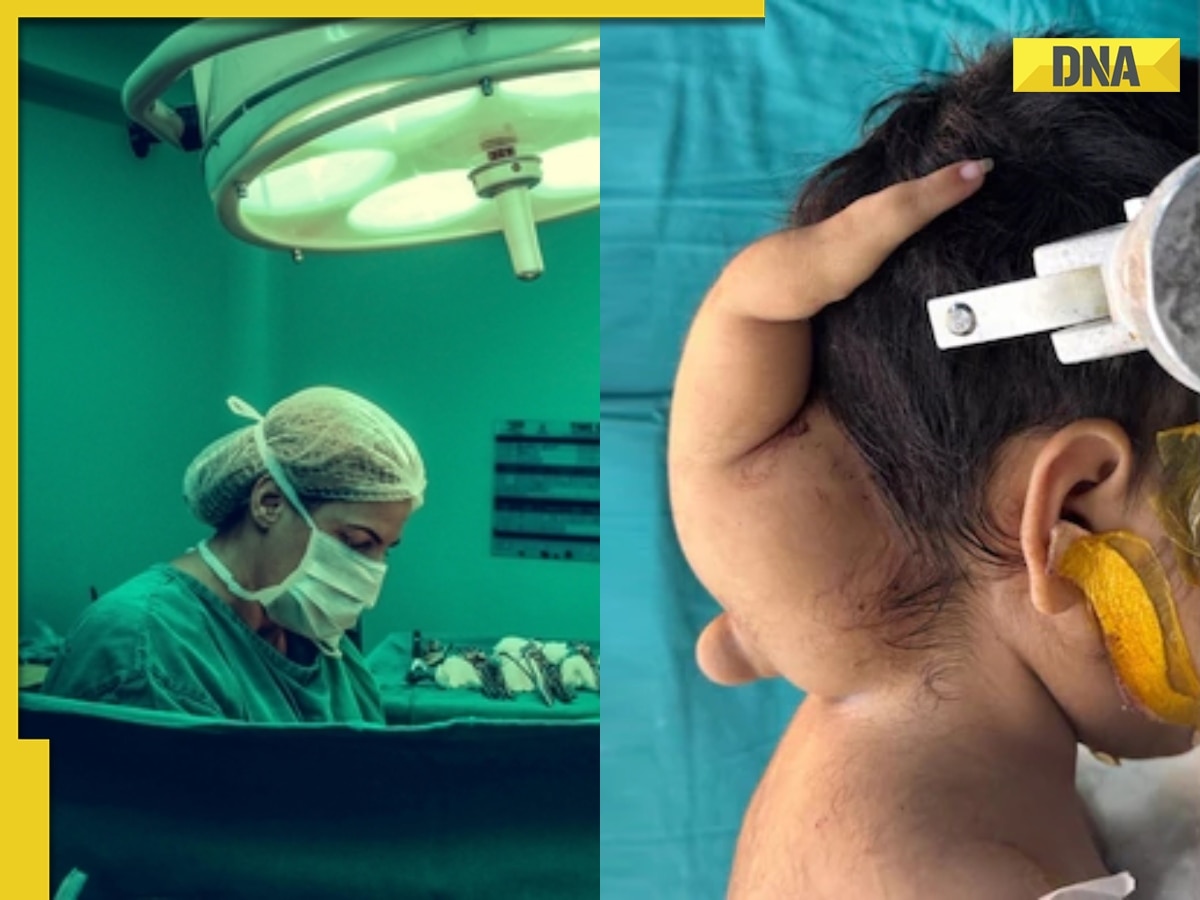 AIIMS doctors perform rare surgery to remove parasitic twin from 3-year-old girl, saves her life