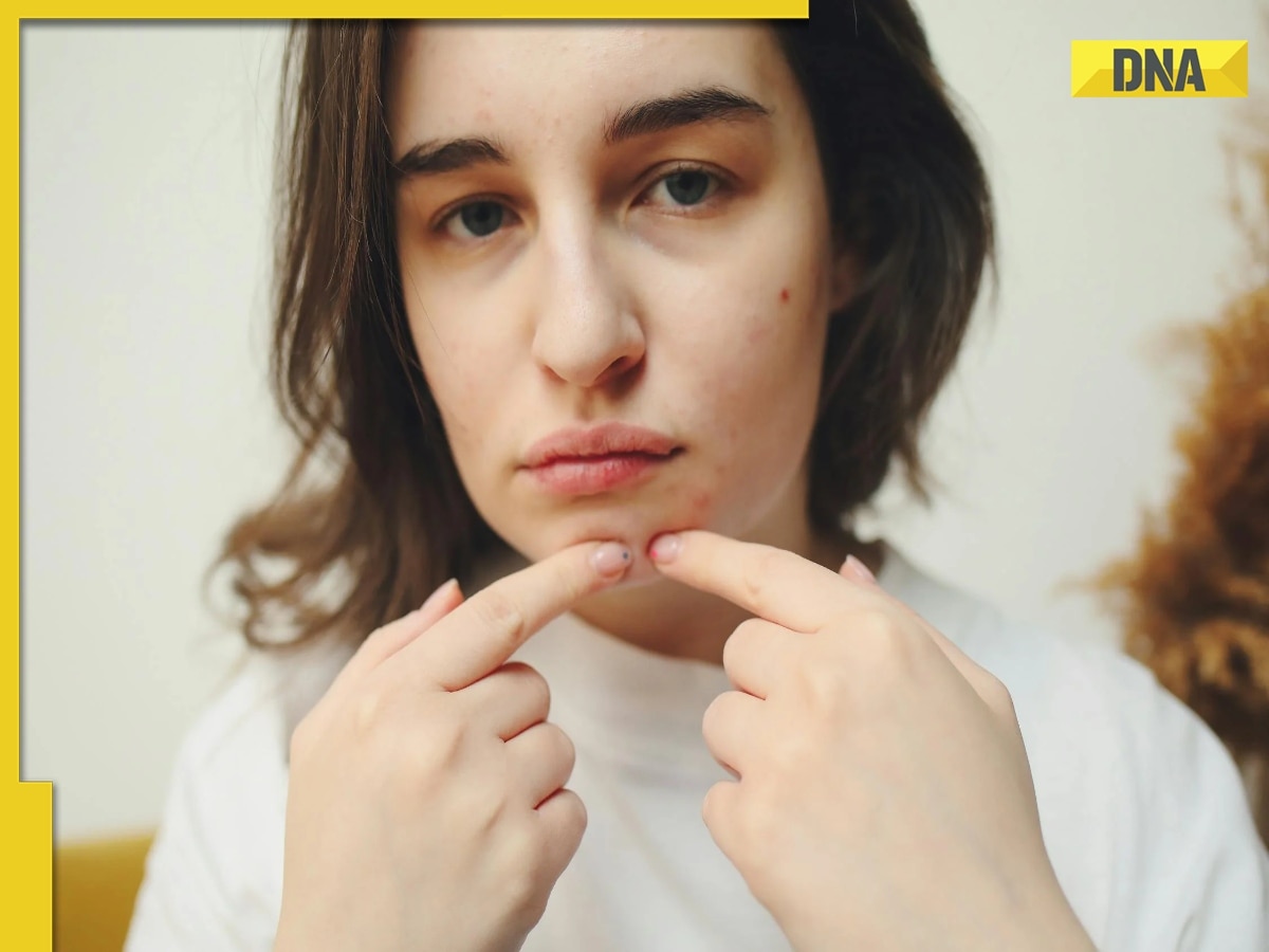 BIZARRE! Man claims his coworker quit job because of a pimple: 'I was so worried' 
