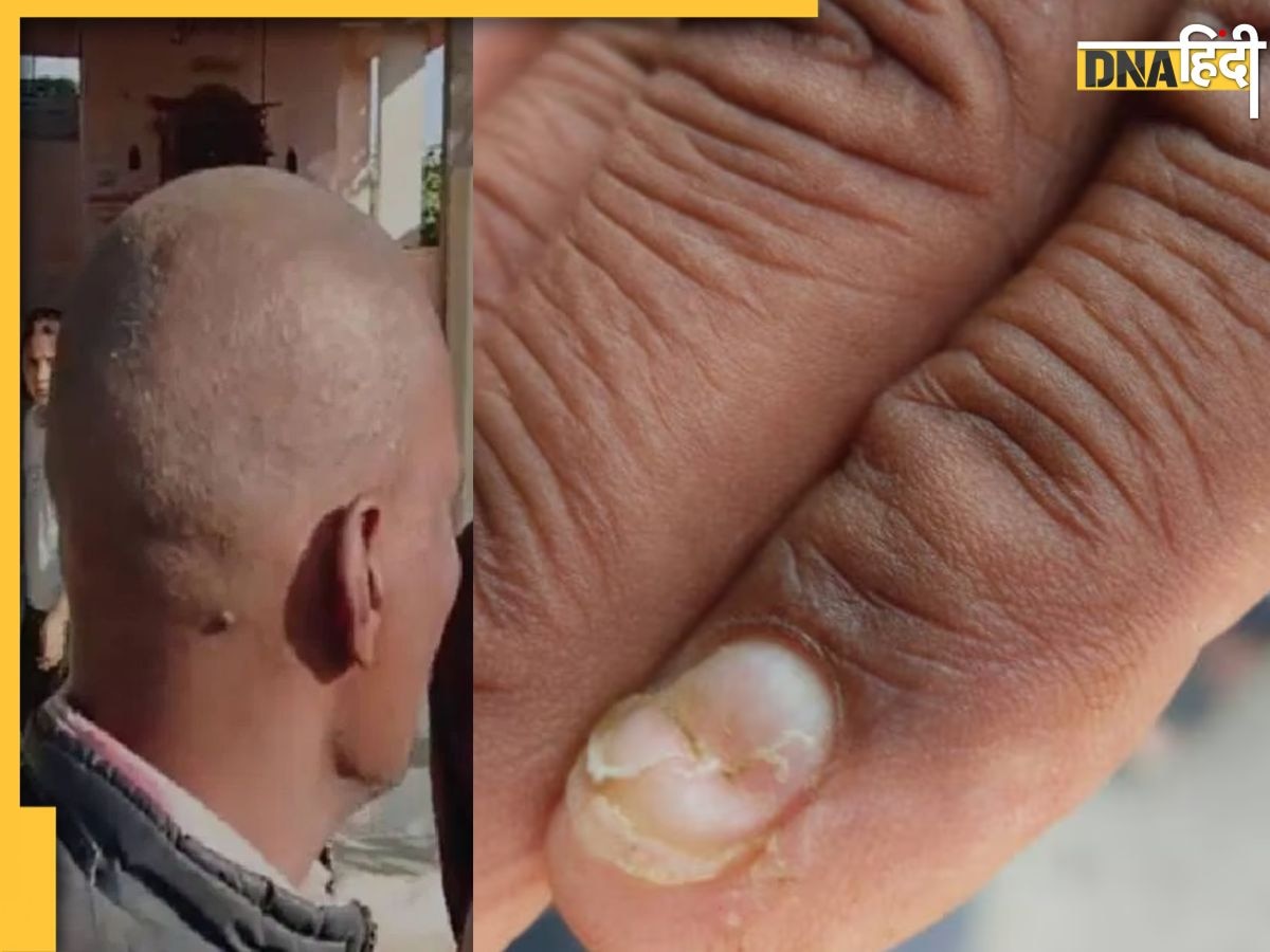 पहले एक रात में हुए गंजे, अब गिरने लगे नाखून, आखिर कौन सी बला का शिकार हुआ है महाराष्ट्र का ये जिला