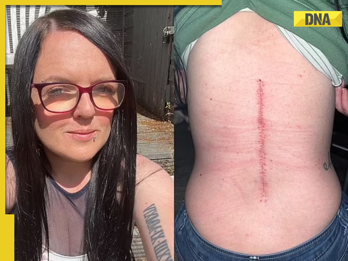 Woman in UK suffering from back pain for 10 years, turns out it was...