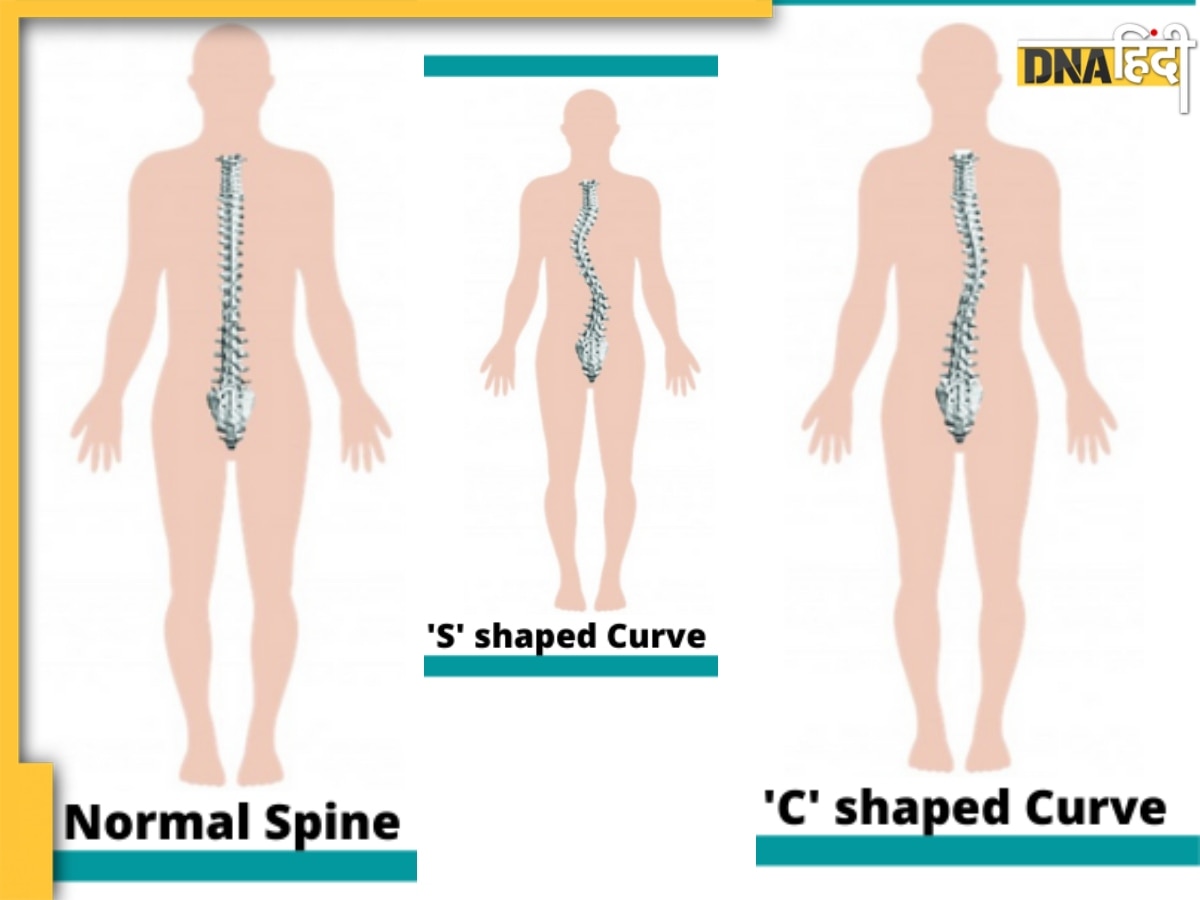 क्या है Scoliosis? जानें रीढ़ की हड्डी से जुड़ी इस खतरनाक बीमारी के लक्षण