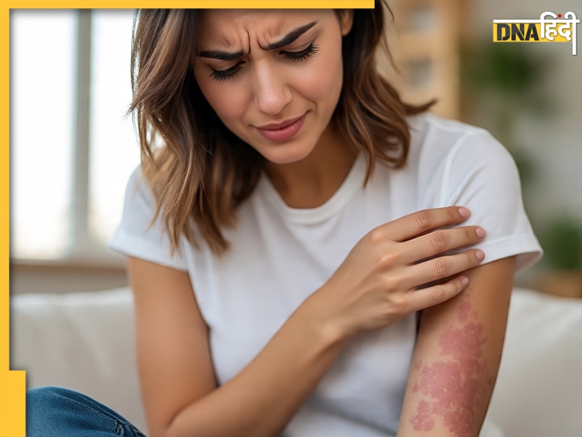 Dengue Cases In Delhi: दिल्ली में डेंगू के बढ़े मामले, आपको शरीर में दिखें ये लक्षण तो तुरंत कराएं जांच